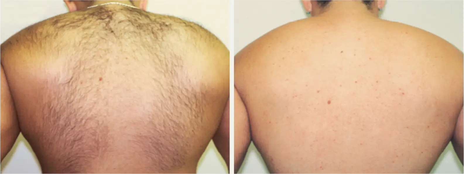 laser-hair-removal-jacksonville_5