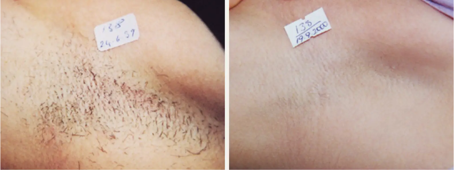 laser-hair-removal-jacksonville_6