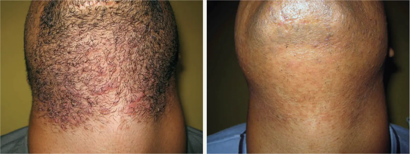 laser-hair-removal-jacksonville_8